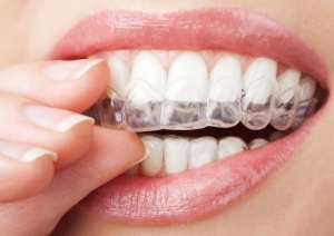 Studio Dentistico Chiavassa Brescia Invisalign