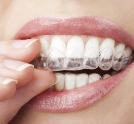 Invisalign Brescia Dott.ssa Chiavassa