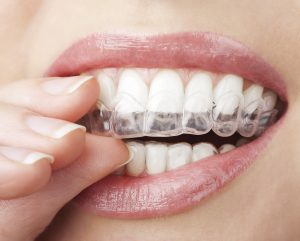 Invisalign Brescia Dott.ssa Chiavassa