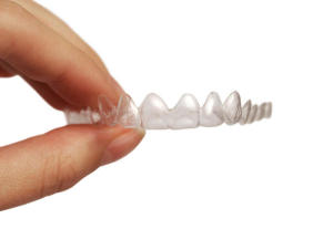 Invisalign Brescia Dott.ssa Chiavassa