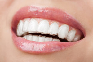 Invisalign Brescia Dott.ssa Chiavassa